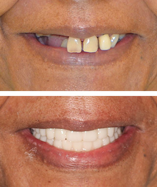 Dental Implants Before and After - Case #3 Dental Implants Before and After - Case #3