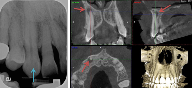 Infected Canine Tooth