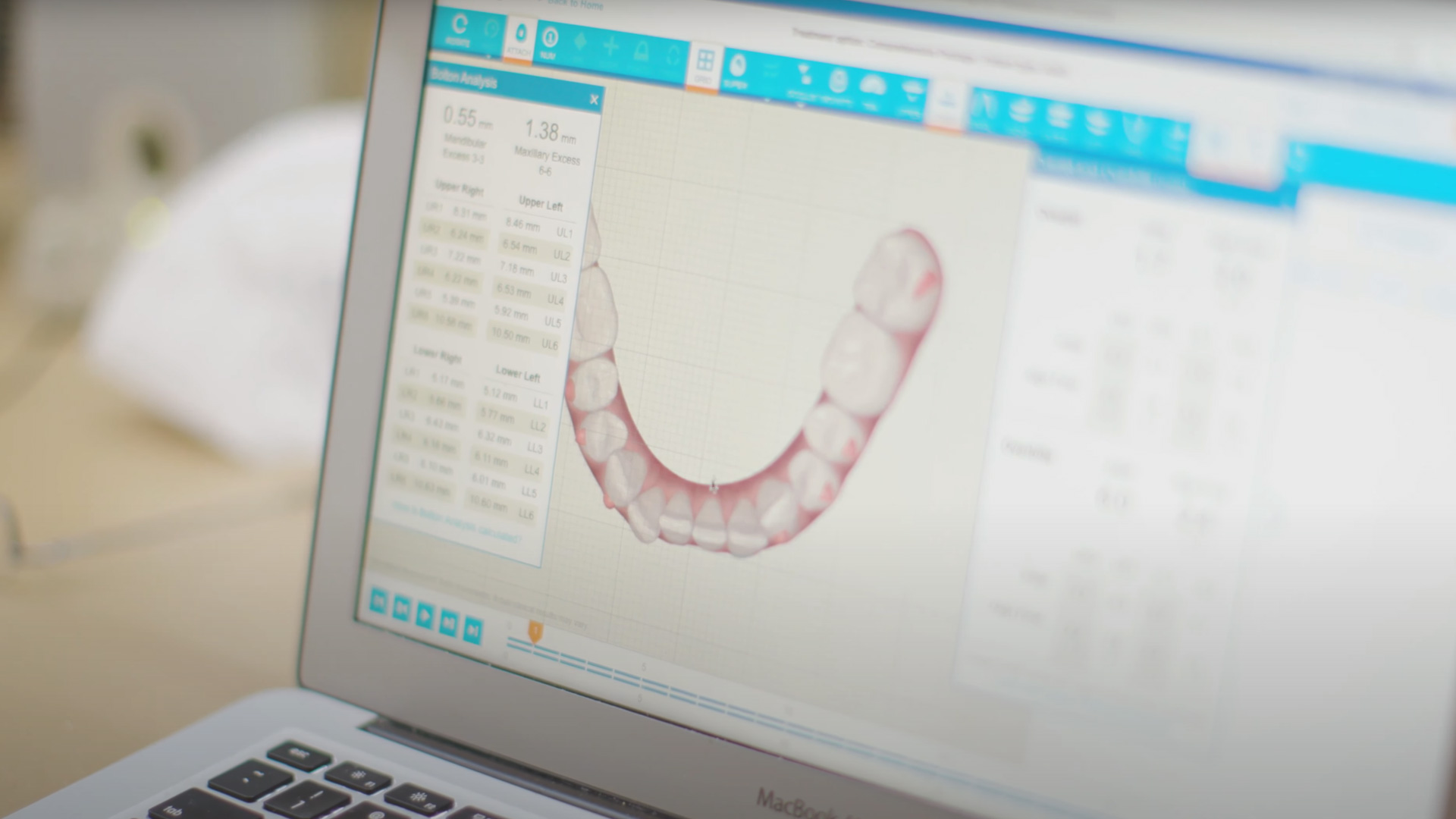 Invisalign Clear Aligners