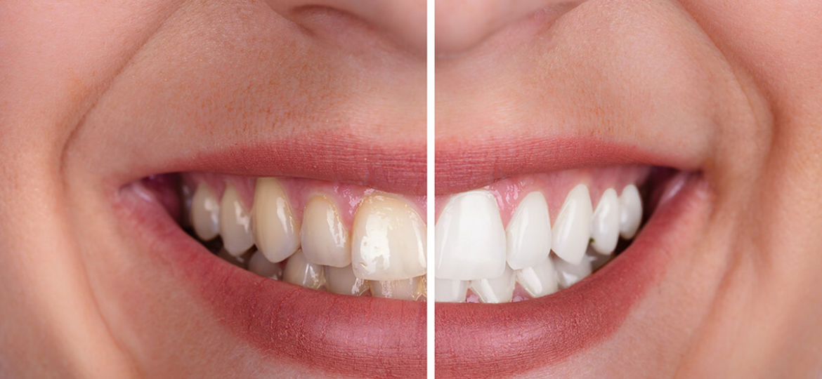 Is Tooth Whitening Bad for My Teeth?