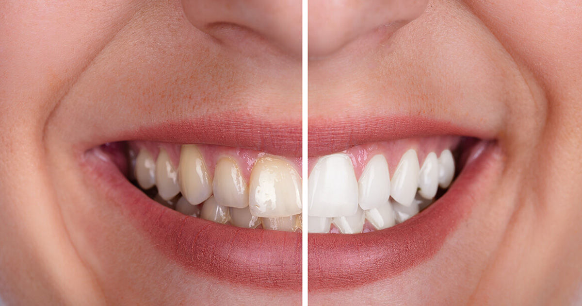 Is Tooth Whitening Bad for My Teeth? Mint Hill Dentistry