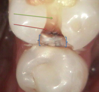 cavity side of molar