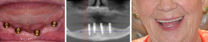Lower implant denture after