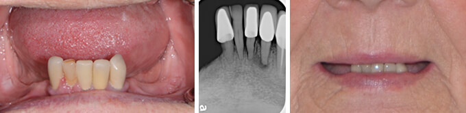 Lower implant denture before