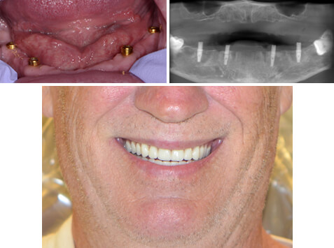 Lower implant dentures after