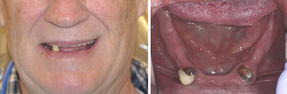Lower implant dentures before