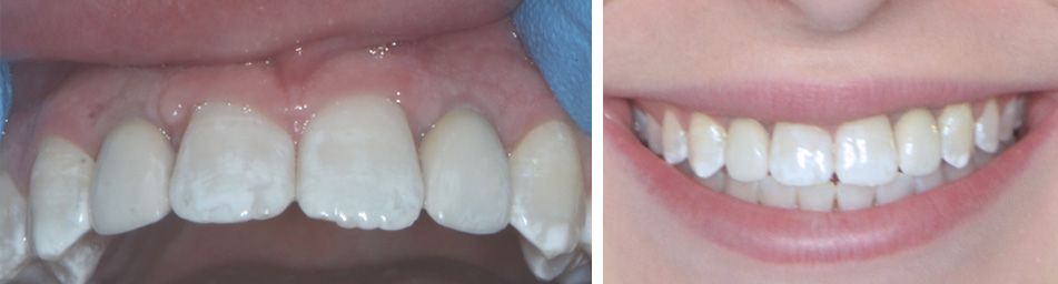 Missing front teeth implant final result