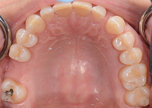 Mouth Showing Missing Tooth