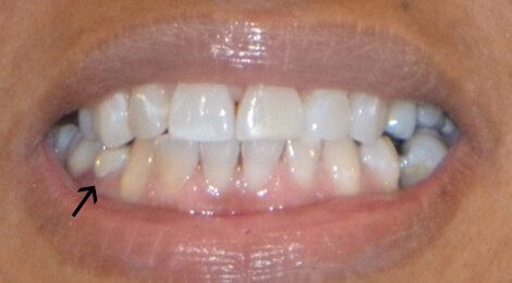 One Week Dental Implant Results