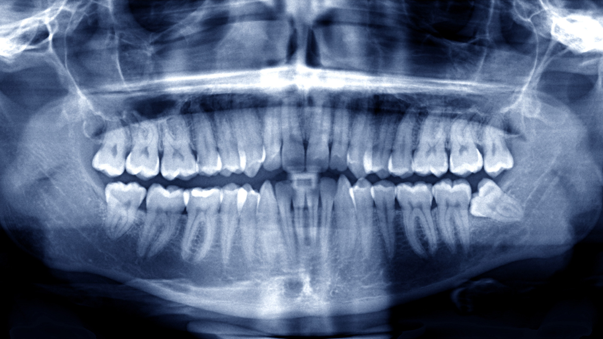 Oral Surgery and Wisdom Teeth