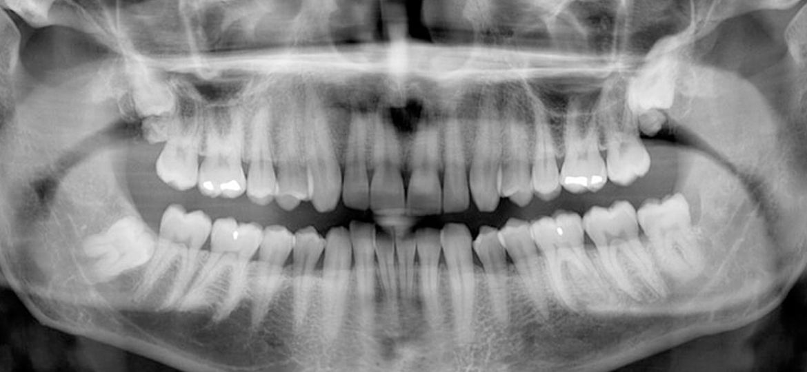 What Exactly is a Panoramic X-Ray?