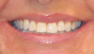 Partial Denture After Photo