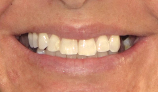 Partial Denture Before Photo