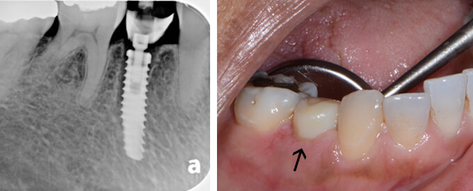 Placement of Implant and Temporary Tooth 