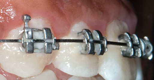 Plaque buildup on braces