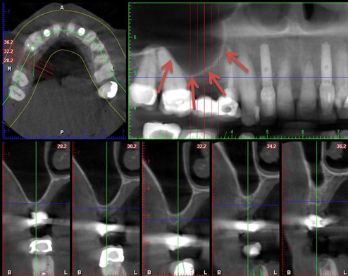 Pneumatized sinus