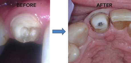 Dental post photo before and after