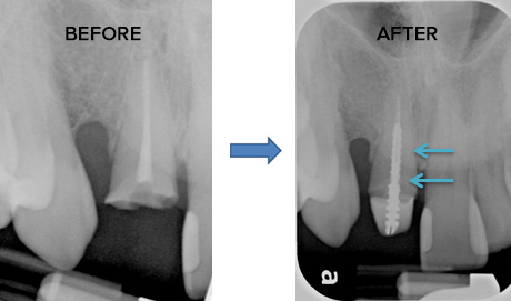 Dental post xray before and after