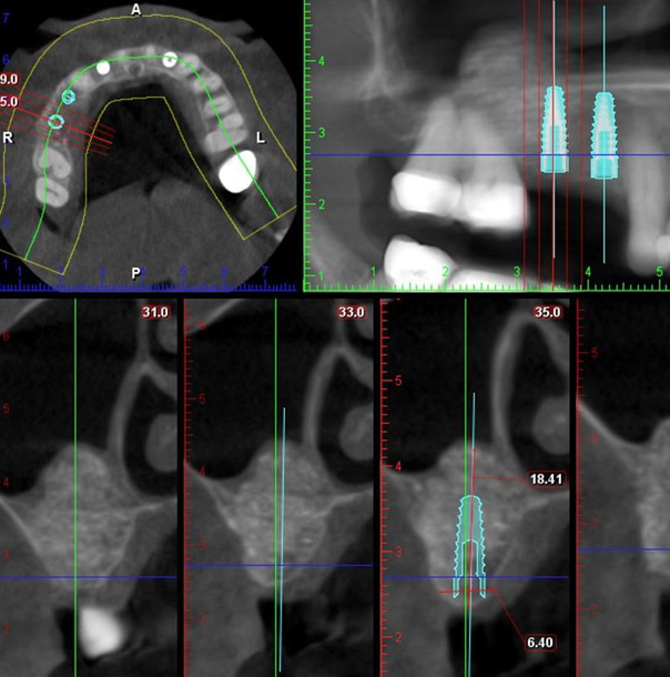 Postop CT Scan – After Sinus Lift