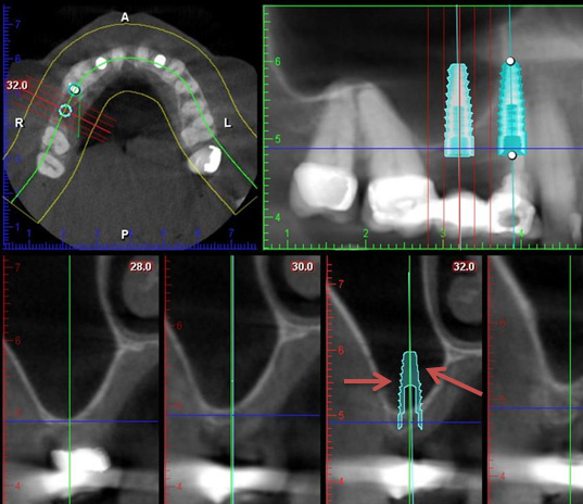 Preoperative CT planning for sinus graft