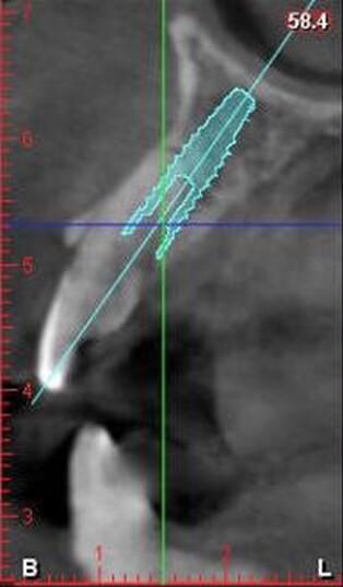 Resorption CT Scan