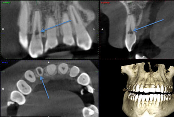 Resorption Diagnosis