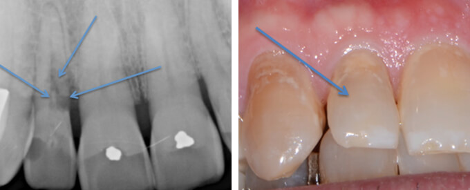 Front tooth resorption case study