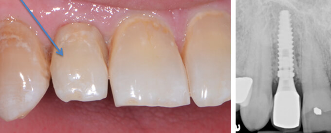 Resorption post surgery