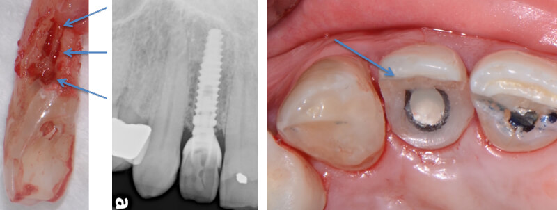 Resorption surgery