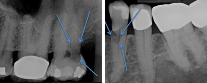 Resorption X-ray