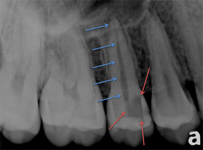 X-ray of large cavity