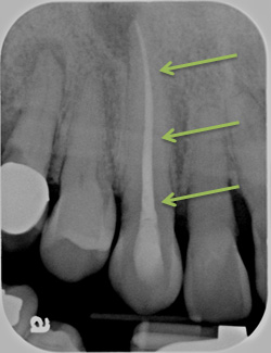 Final root canal x-ray
