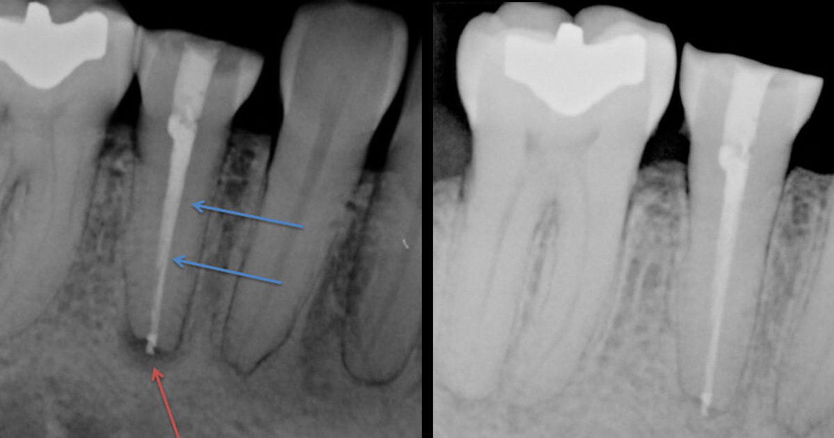 Root Canal Infection Xray