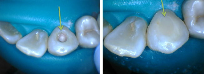 Root canal hole and tooth colored filling