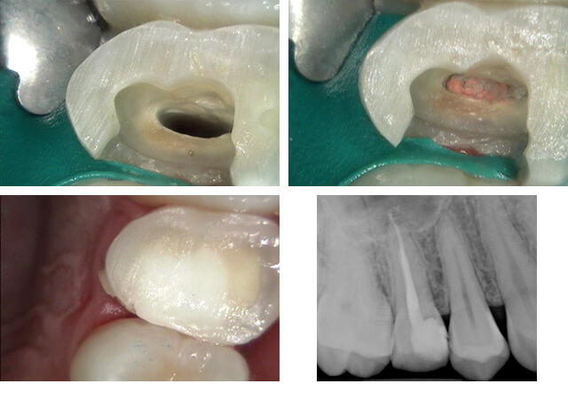 Root canal procedure