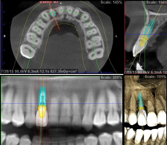 Root Canal Treatment