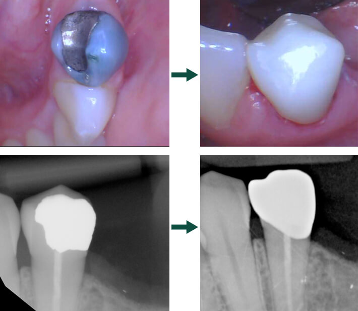 Same day crown before and after