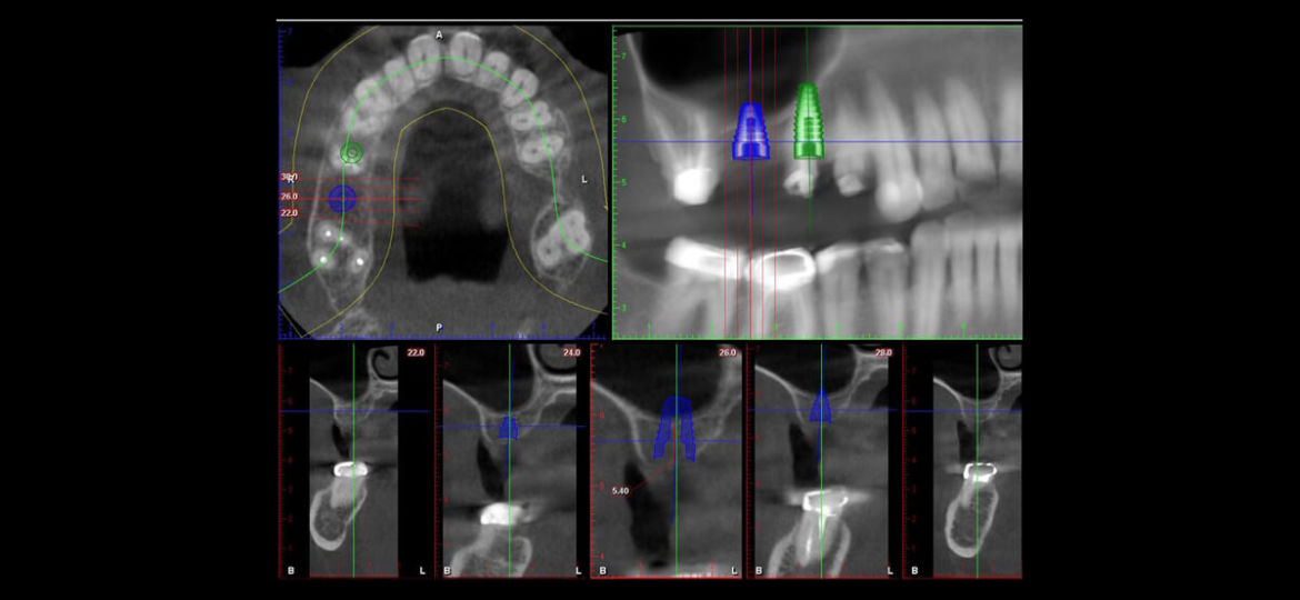 Saving Four Teeth