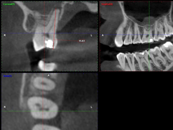 CT imaging to diagnose an infection