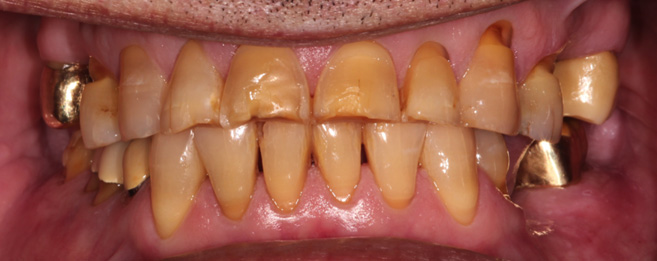 Severe Tooth Wear