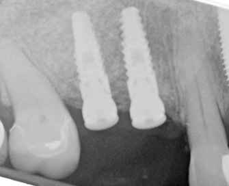 Final surgery for sinus graft with implants