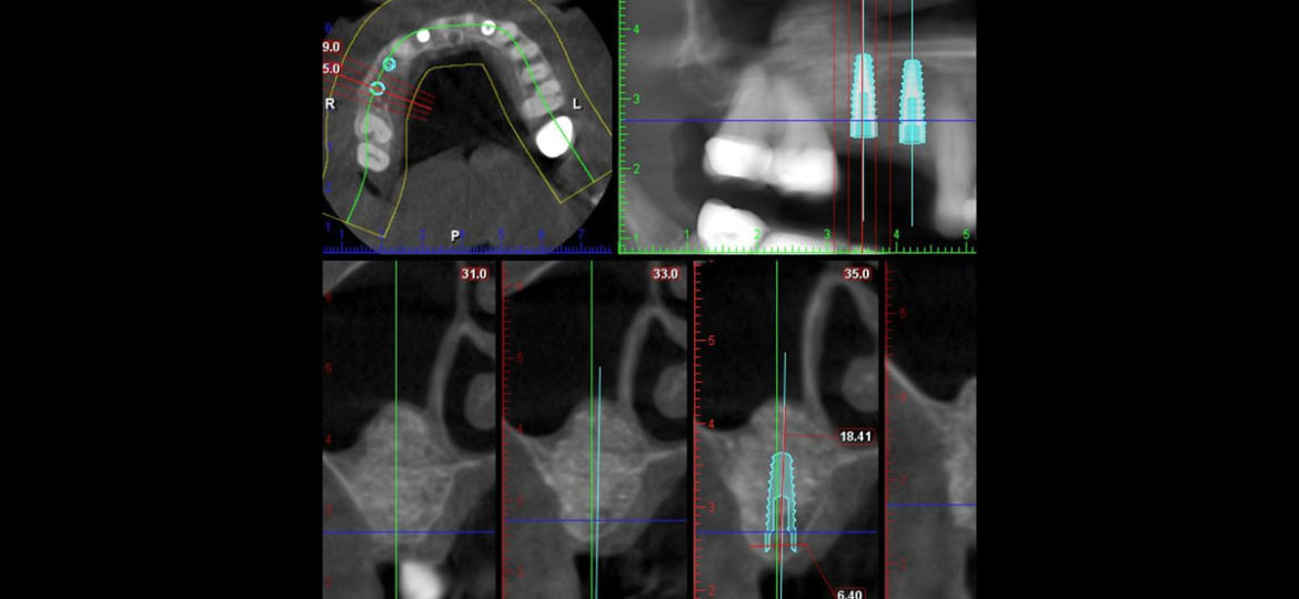 What is a Sinus Lift?