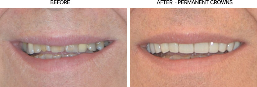 Smile after permanent crowns