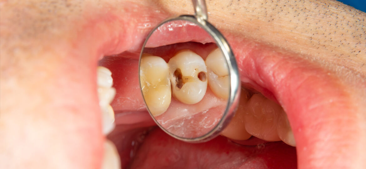 Five stages of tooth decay