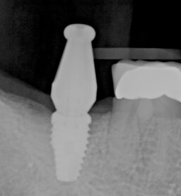 Step one – Place the implant
