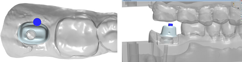 Step 2 - Digital Abutment Design