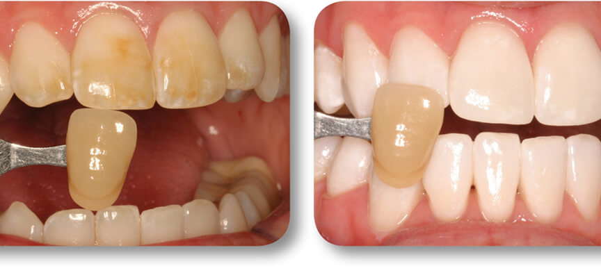 Teeth whitening before and after