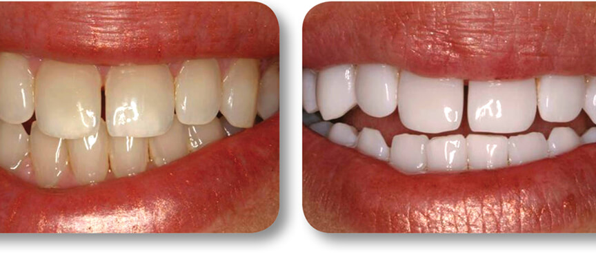 Teeth whitening before and after