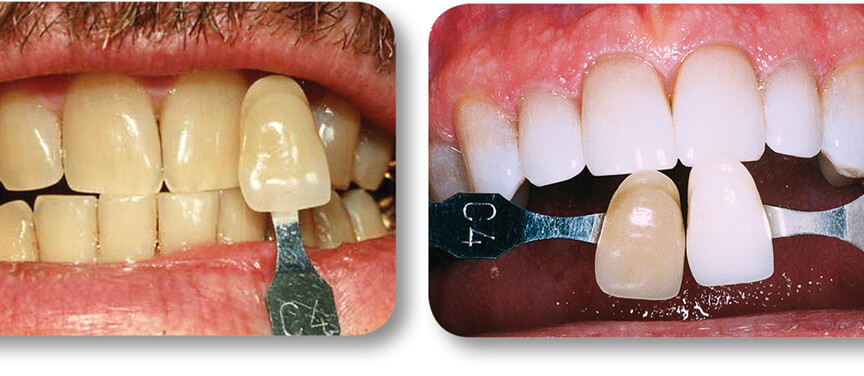 Teeth whitening before and after