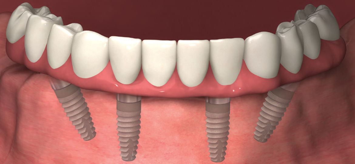 TeethXpress “All on 4” Dental Implants